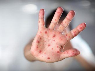Nuevos casos de viruela símica